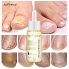 JoyPretty Skin® körömgomba elleni szérum – hatékony kezelés gombás körömre