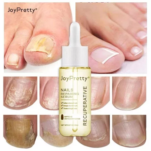 JoyPretty Skin® körömgomba elleni szérum – hatékony kezelés gombás körömre