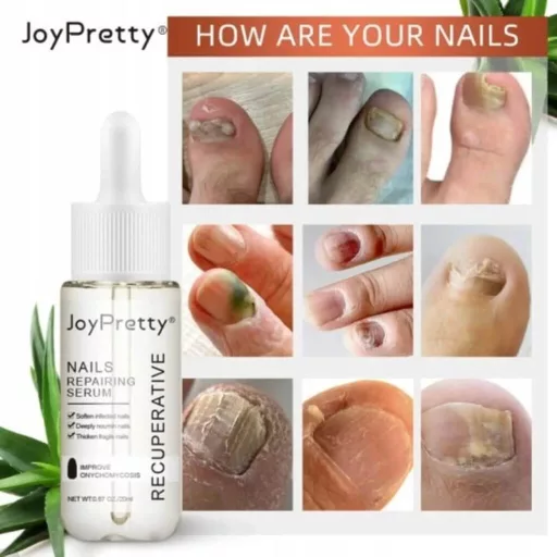 JoyPretty Skin® körömgomba elleni szérum – hatékony kezelés gombás körömre