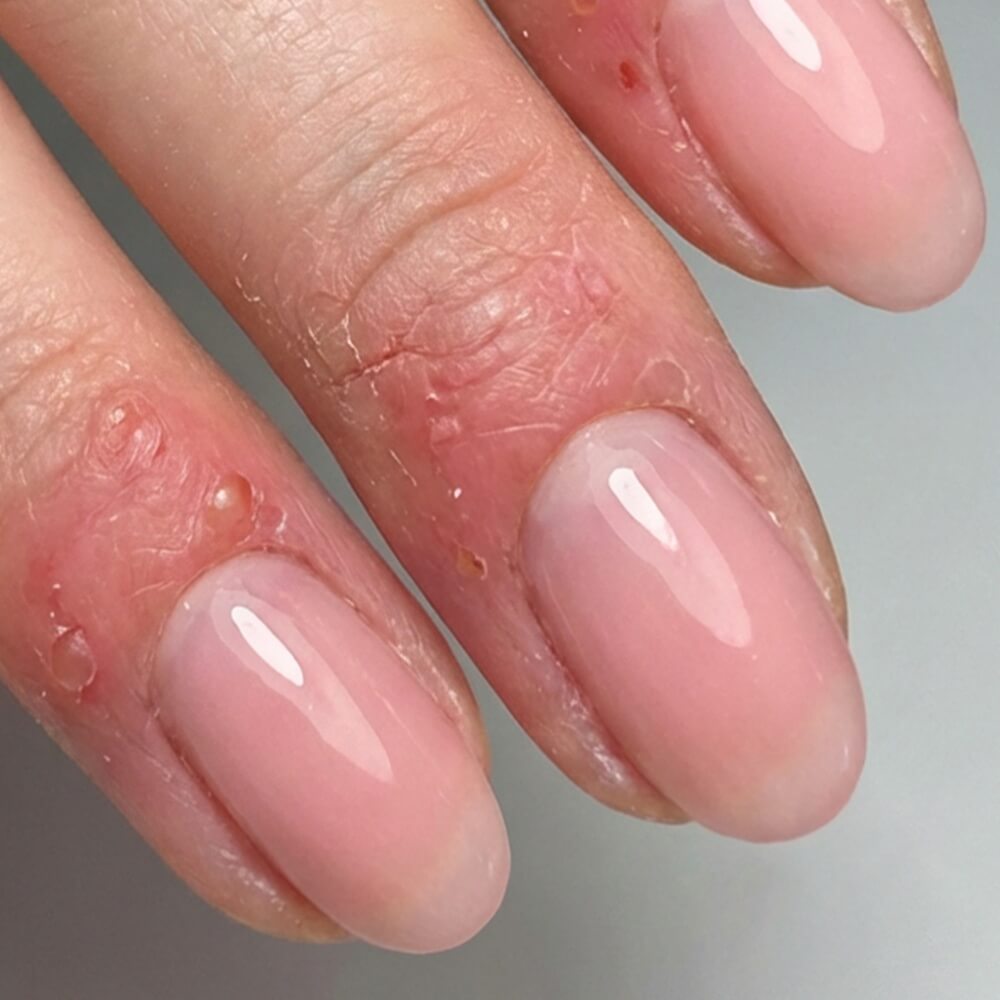 Miért nő a műköröm-allergiások száma?