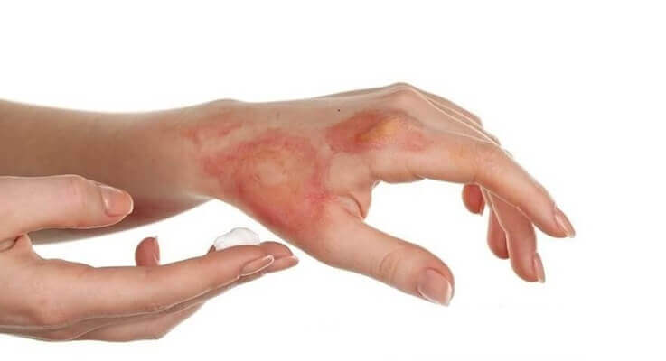 Bőrregeneráló krém kenderolajjal – irritált bőrre